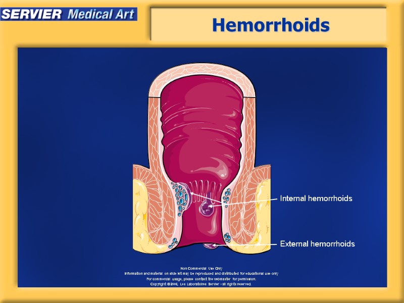 Hemorrhoids Internal hemorrhoids External hemorrhoids